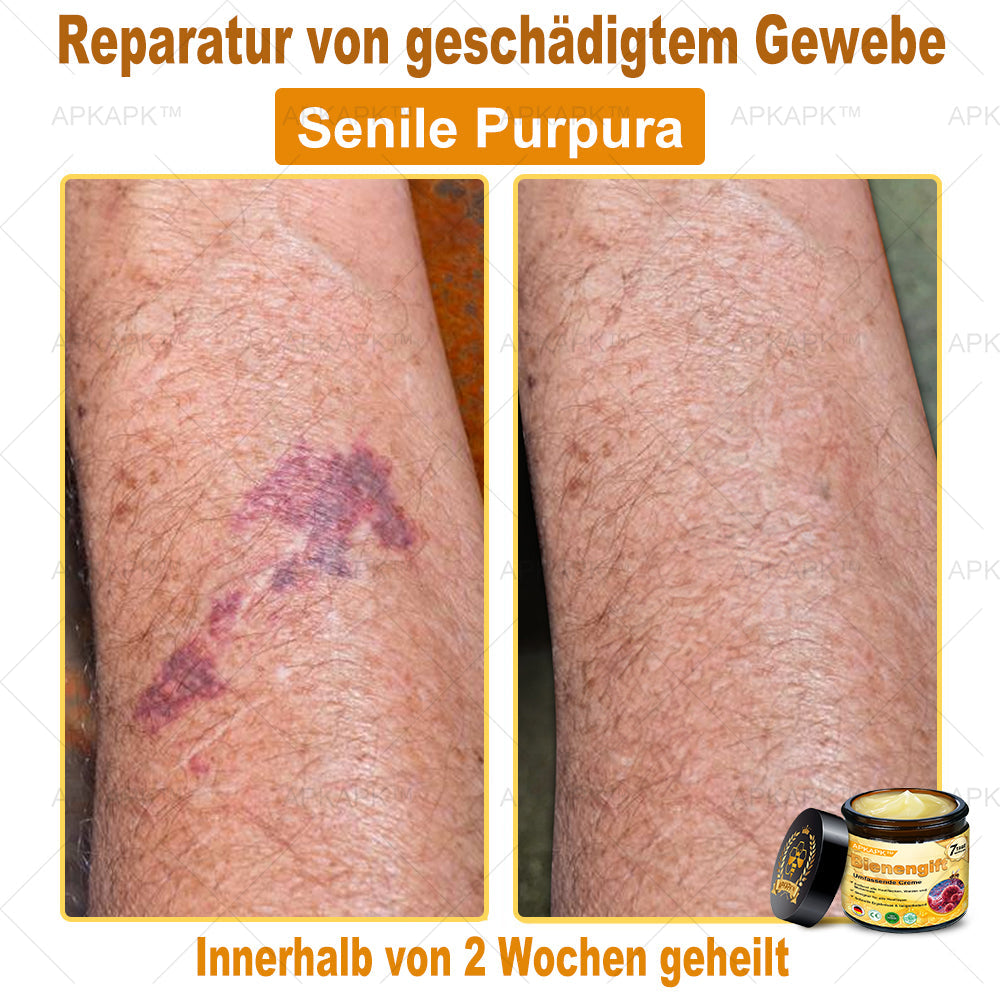 Hergestellt in Deutschland ✨AРKAРК™ Bienengift Umfassende Creme – Anti-Aging, Feuchtigkeitsspendend, Hautreparatur, Hautbildverbesserung, Akne- und Pigmentfleckenbehandlung, Warzen- und Muttermalentfernung, Linderung bei Psoriasis