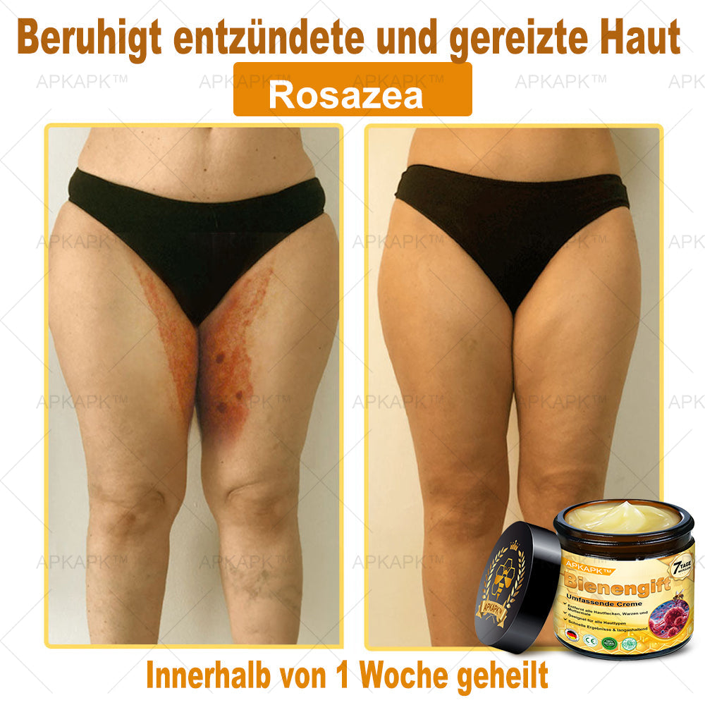 Hergestellt in Deutschland ✨AРKAРК™ Bienengift Umfassende Creme – Anti-Aging, Feuchtigkeitsspendend, Hautreparatur, Hautbildverbesserung, Akne- und Pigmentfleckenbehandlung, Warzen- und Muttermalentfernung, Linderung bei Psoriasis