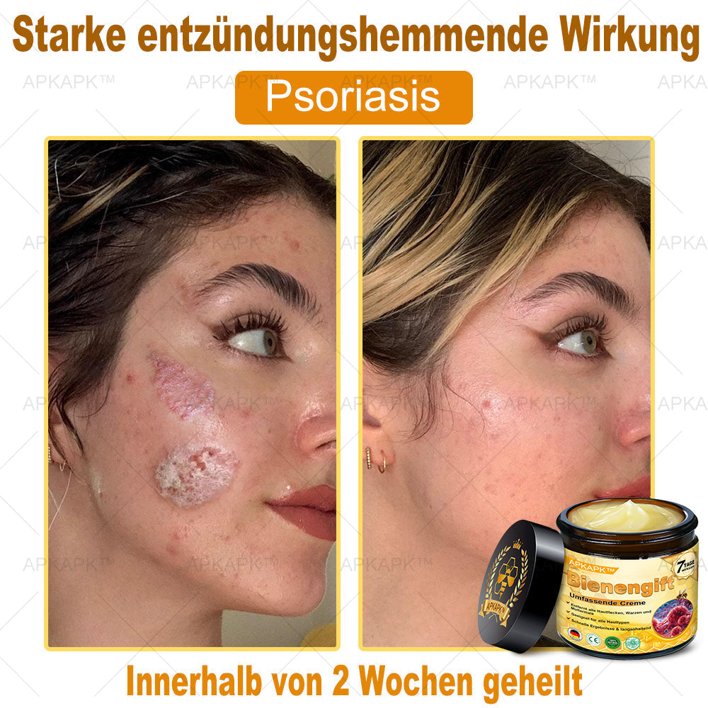 Hergestellt in Deutschland ✨AРKAРК™ Bienengift Umfassende Creme – Anti-Aging, Feuchtigkeitsspendend, Hautreparatur, Hautbildverbesserung, Akne- und Pigmentfleckenbehandlung, Warzen- und Muttermalentfernung, Linderung bei Psoriasis