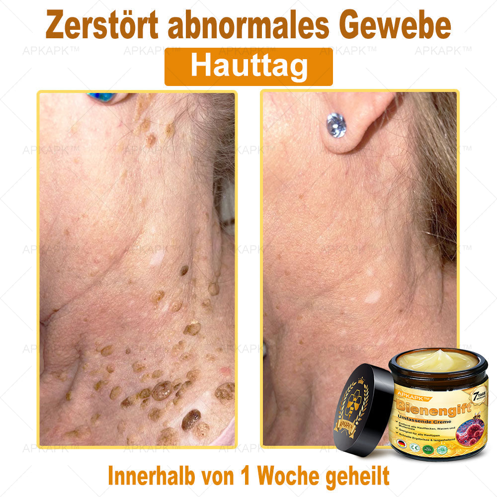 Hergestellt in Deutschland ✨AРKAРК™ Bienengift Umfassende Creme – Anti-Aging, Feuchtigkeitsspendend, Hautreparatur, Hautbildverbesserung, Akne- und Pigmentfleckenbehandlung, Warzen- und Muttermalentfernung, Linderung bei Psoriasis
