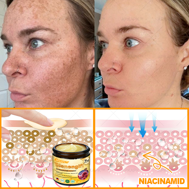 Hergestellt in Deutschland ✨AРKAРК™ Bienengift Umfassende Creme – Anti-Aging, Feuchtigkeitsspendend, Hautreparatur, Hautbildverbesserung, Akne- und Pigmentfleckenbehandlung, Warzen- und Muttermalentfernung, Linderung bei Psoriasis