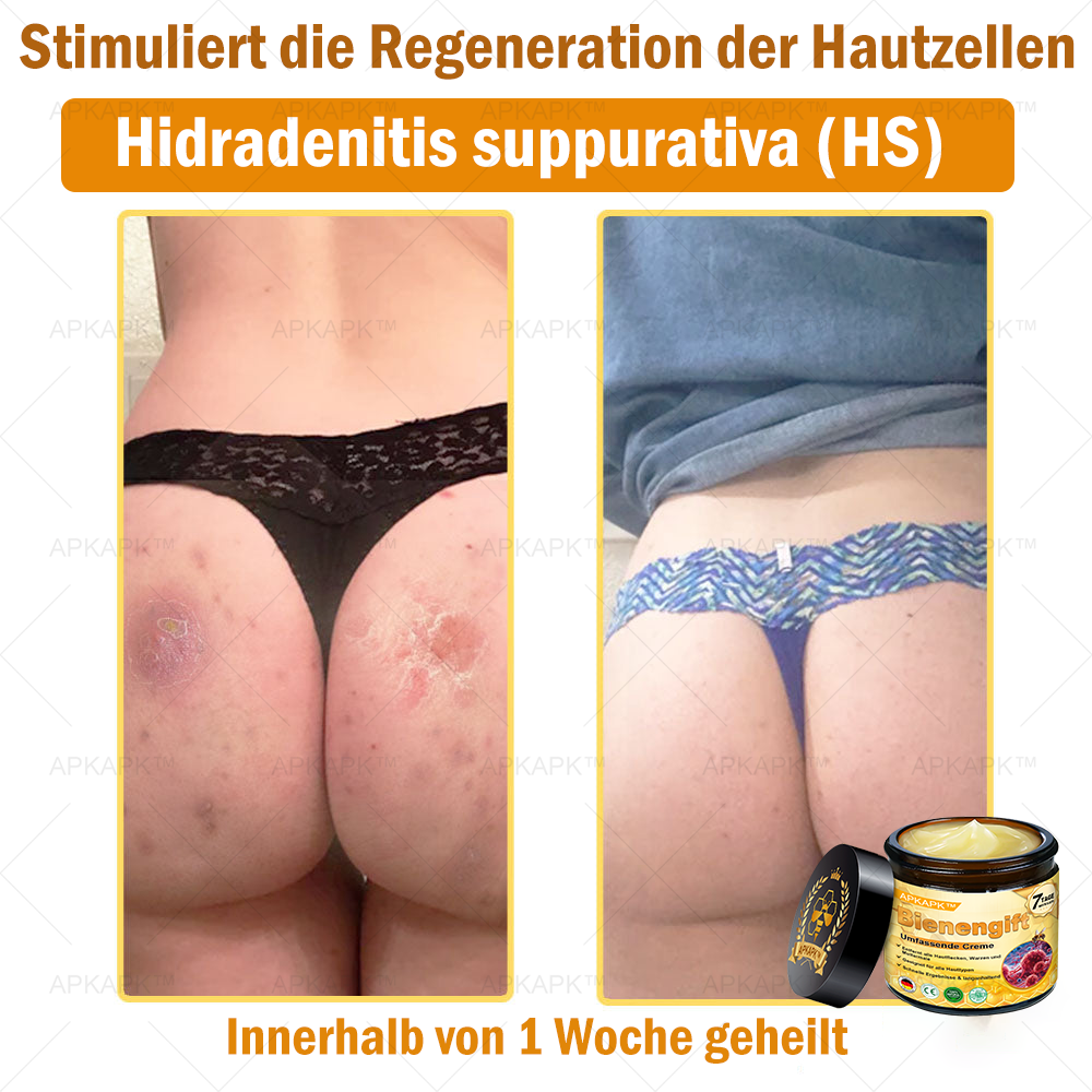 Hergestellt in Deutschland ✨AРKAРК™ Bienengift Umfassende Creme – Anti-Aging, Feuchtigkeitsspendend, Hautreparatur, Hautbildverbesserung, Akne- und Pigmentfleckenbehandlung, Warzen- und Muttermalentfernung, Linderung bei Psoriasis