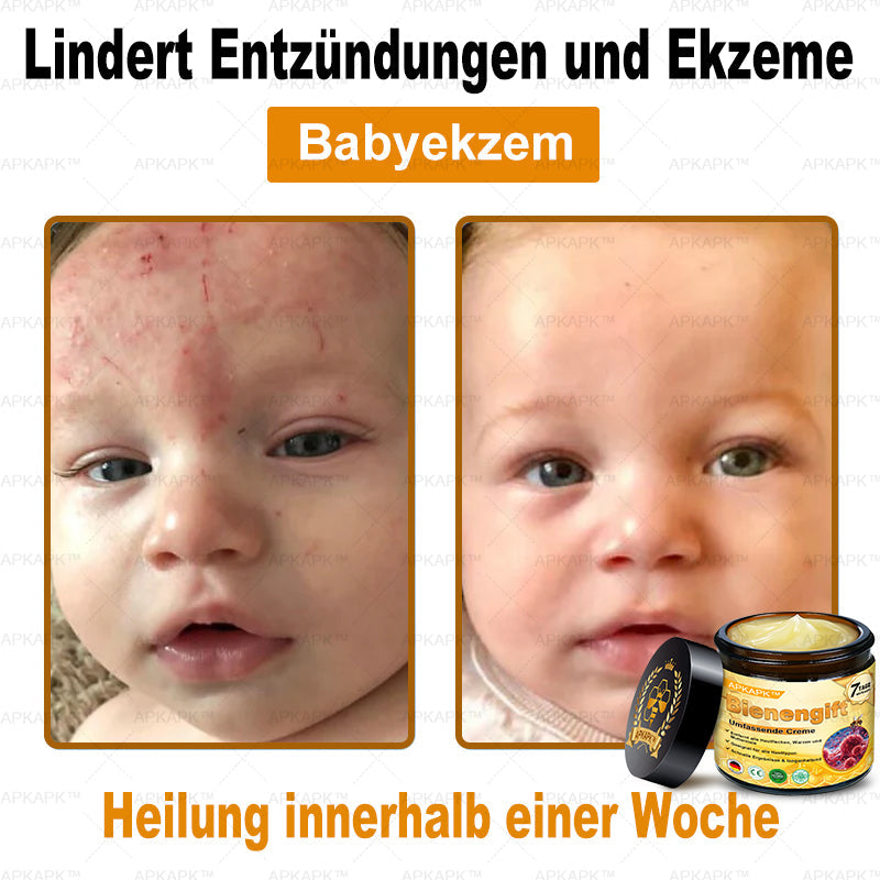 Hergestellt in Deutschland ✨AРKAРК™ Bienengift Umfassende Creme – Anti-Aging, Feuchtigkeitsspendend, Hautreparatur, Hautbildverbesserung, Akne- und Pigmentfleckenbehandlung, Warzen- und Muttermalentfernung, Linderung bei Psoriasis