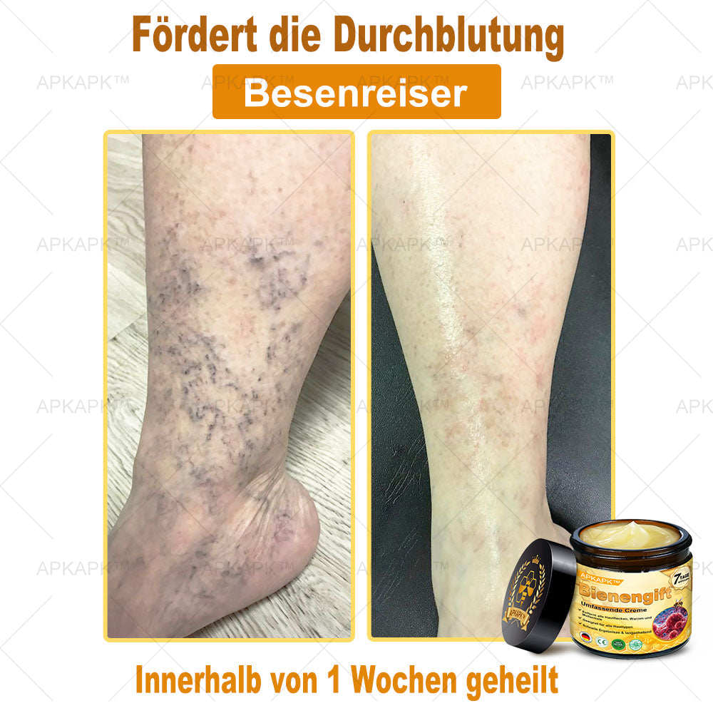 Hergestellt in Deutschland ✨AРKAРК™ Bienengift Umfassende Creme – Anti-Aging, Feuchtigkeitsspendend, Hautreparatur, Hautbildverbesserung, Akne- und Pigmentfleckenbehandlung, Warzen- und Muttermalentfernung, Linderung bei Psoriasis