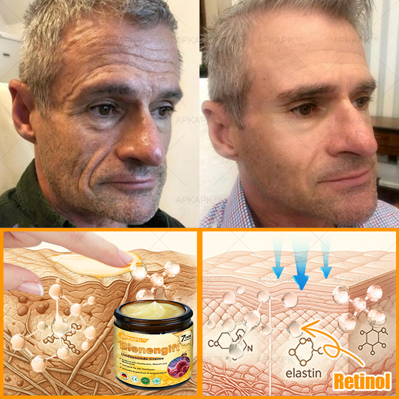 Hergestellt in Deutschland ✨AРKAРК™ Bienengift Umfassende Creme – Anti-Aging, Feuchtigkeitsspendend, Hautreparatur, Hautbildverbesserung, Akne- und Pigmentfleckenbehandlung, Warzen- und Muttermalentfernung, Linderung bei Psoriasis