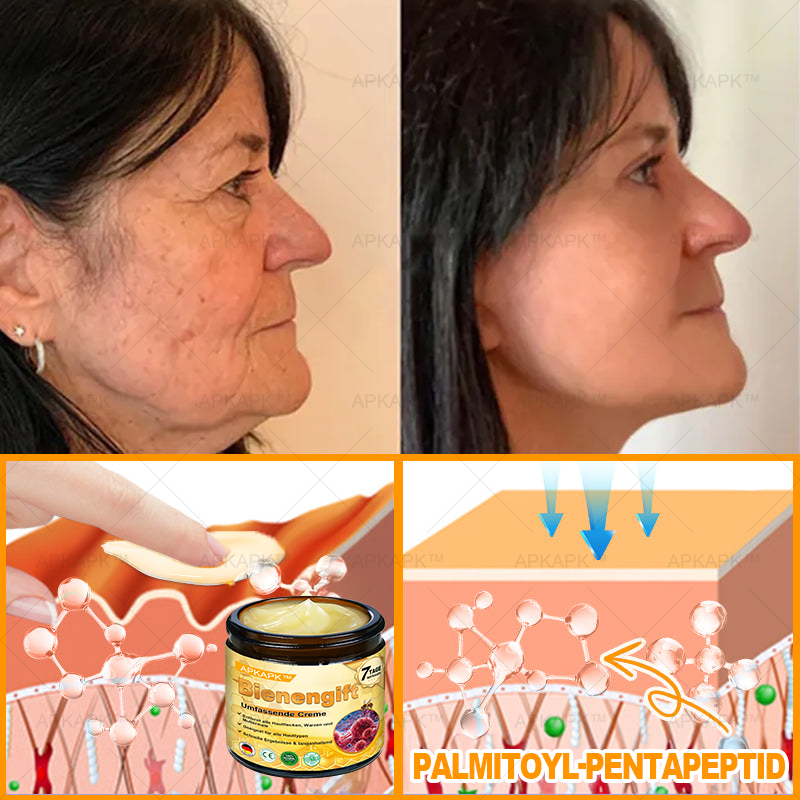 Hergestellt in Deutschland ✨AРKAРК™ Bienengift Umfassende Creme – Anti-Aging, Feuchtigkeitsspendend, Hautreparatur, Hautbildverbesserung, Akne- und Pigmentfleckenbehandlung, Warzen- und Muttermalentfernung, Linderung bei Psoriasis