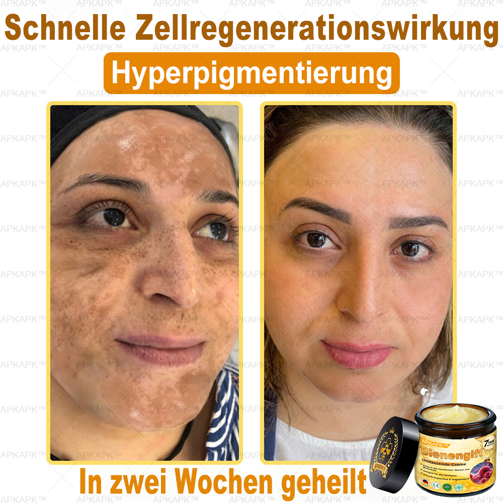 Hergestellt in Deutschland ✨AРKAРК™ Bienengift Umfassende Creme – Anti-Aging, Feuchtigkeitsspendend, Hautreparatur, Hautbildverbesserung, Akne- und Pigmentfleckenbehandlung, Warzen- und Muttermalentfernung, Linderung bei Psoriasis