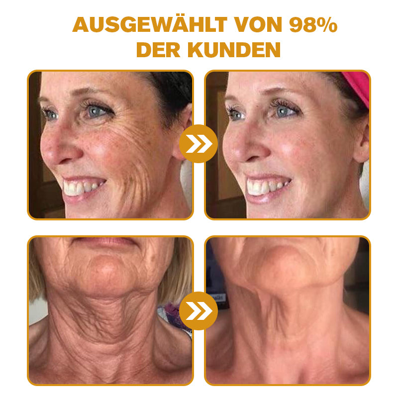 Hergestellt in Deutschland ✨AРKAРК™ Bienengift Umfassende Creme – Anti-Aging, Feuchtigkeitsspendend, Hautreparatur, Hautbildverbesserung, Akne- und Pigmentfleckenbehandlung, Warzen- und Muttermalentfernung, Linderung bei Psoriasis